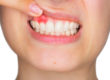 gums being examined, how to prevent tooth decay naturally