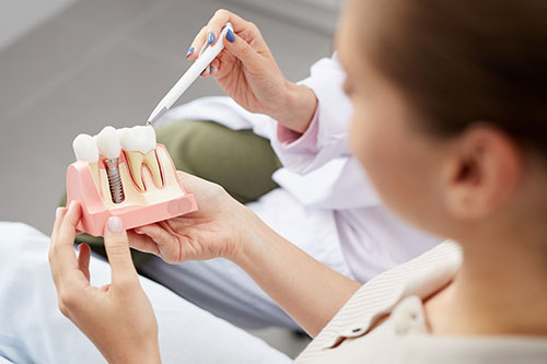 Dental-Implants a dentist holds a model of dental implants