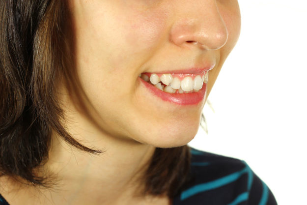 how to prevent teeth shifting (1) woman smiling with teeth shifting