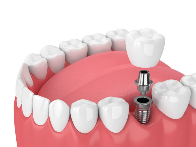 an rending of a types of dental implants