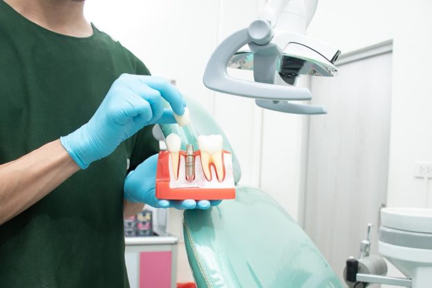 implant specialist a doctor showing implant specialist