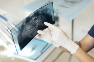 a doctor looking at x rays of impacted teeth