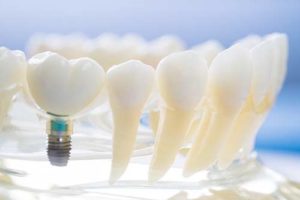 a sample of dental implants