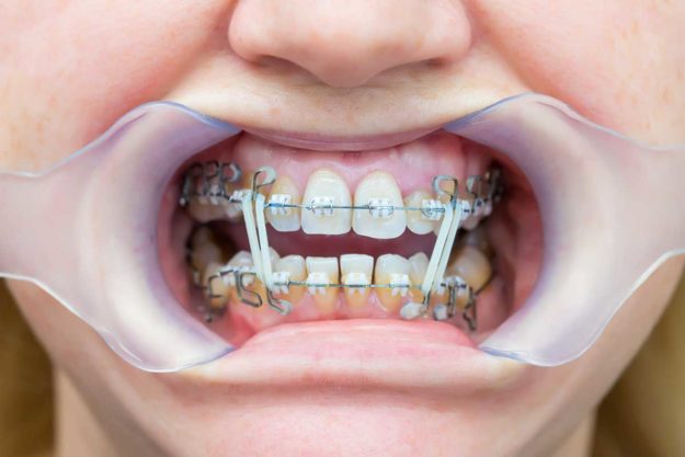 1-3-Benefits-of-Adult-Orthodontic-Services (1) example of adult orthodontics services