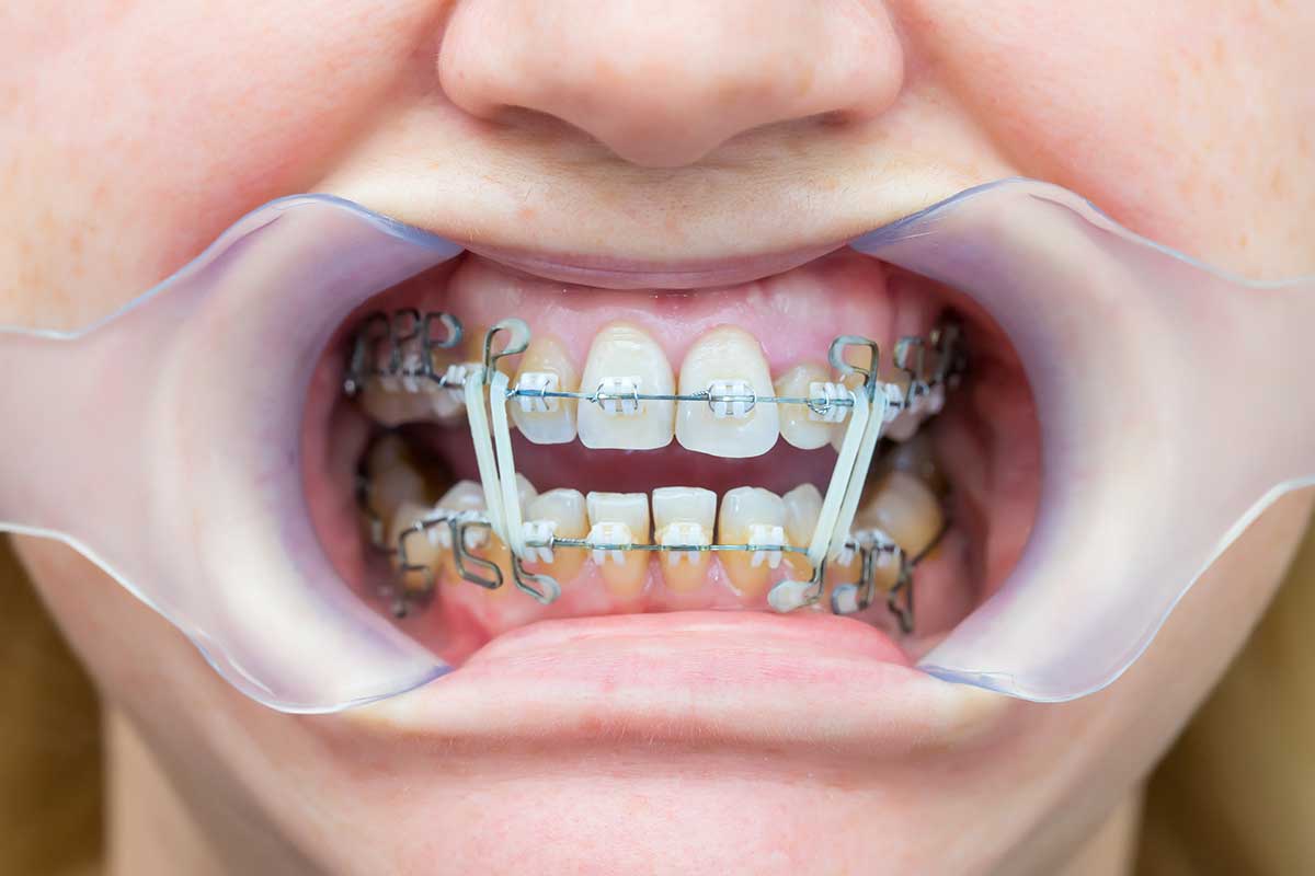 1-3-Benefits-of-Adult-Orthodontic-Services (1) example of adult orthodontics services