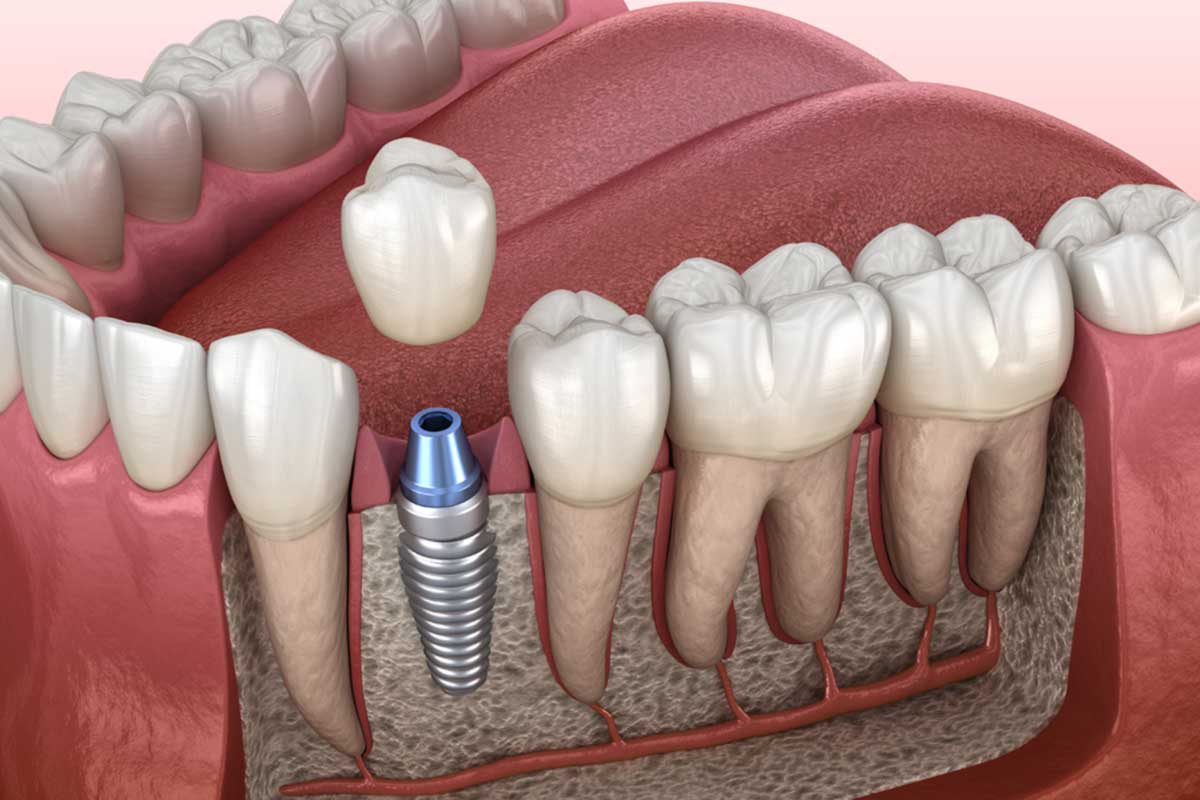 What Is a Single Tooth Implant? Dental Implants Texas