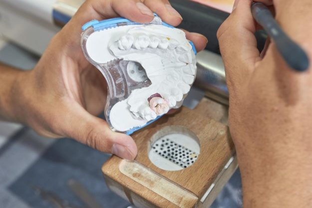 How Do Dental Implants Work (5) dentist working on dental implants