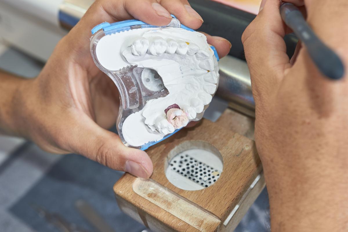 How Do Dental Implants Work (5) dentist working on dental implants