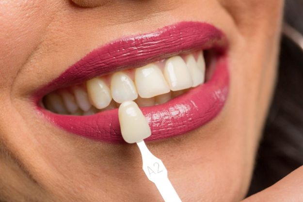 5 Benefits of Dental Veneers (6) woman being fitted for dental veneers